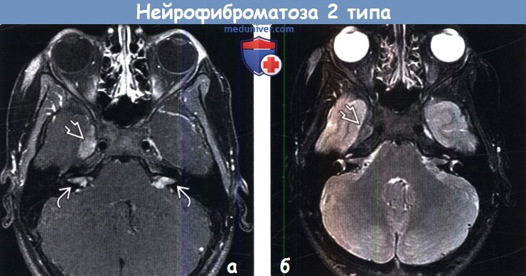 Нейрофиброматоз 2 типа на МРТ головного мозга