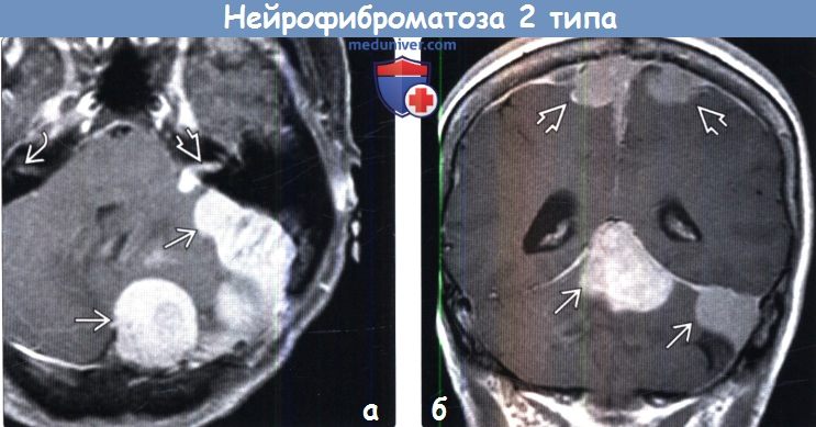 Нейрофиброматоз 2 типа на МРТ головного мозга