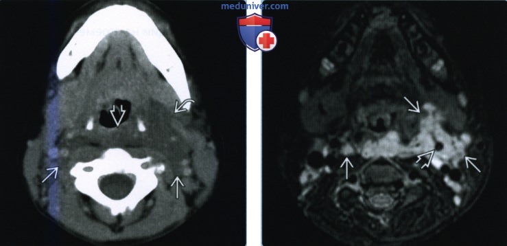 Нейрофиброматоз первого типа головы и шеи - лучевая диагностика