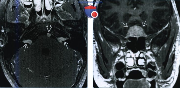 Нейрофиброматоз второго типа головы и шеи - лучевая диагностика