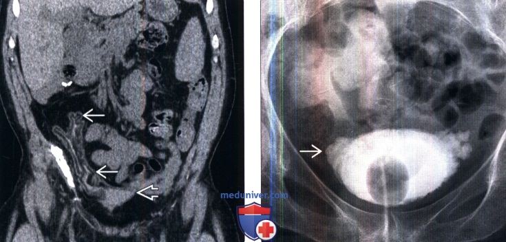 После тур мочевого. Трабекулярный мочевой пузырь рентген. Нейрогенный мочевой пузырь цистография. Нейрогенный мочевой пузырь кт. Трабекулярный мочевой пузырь на кт.