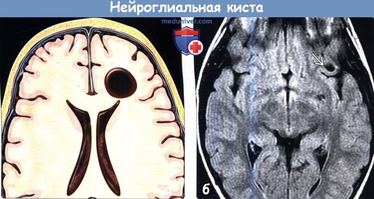 Арахноидальная киста головного мозга