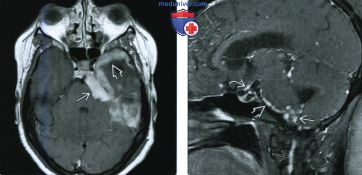 Нейросаркоидоз мостомозжечкового угла (ММУ) и внутреннего слухового канала (ВСК)