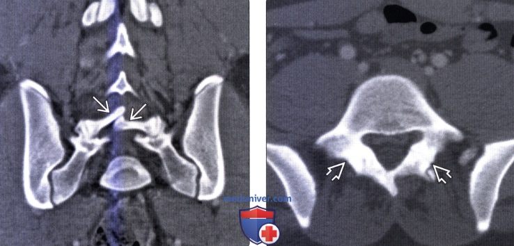 Рентгенограмма, КТ, МРТ при неполном слиянии позвонка (Spina bifida occulta)