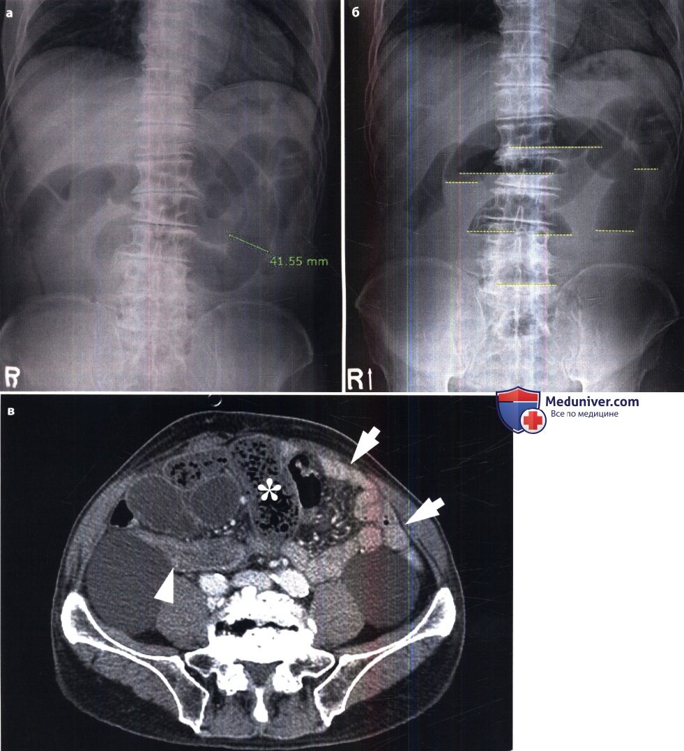 Рентген при острой кишечной непроходимости