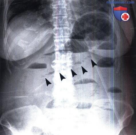 Рентген при острой кишечной непроходимости