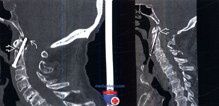 Рентгенограмма, КТ при несостоятельности металлоконструкции позвоночника
