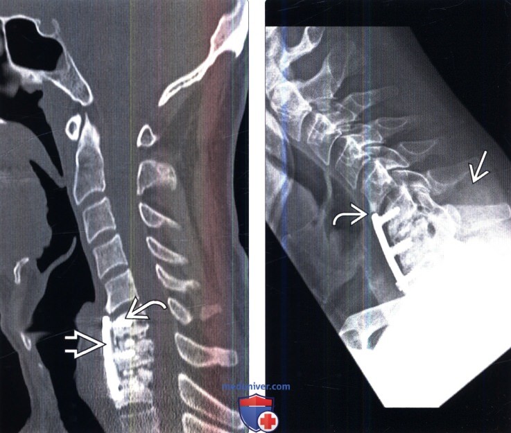 Рентгенограмма, КТ при несостоятельности металлоконструкции позвоночника