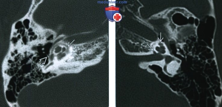 Несовершенный остеогенез височной кости - лучевая диагностика