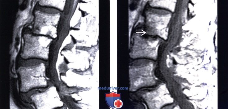 Нестабильность дисков шейного отдела позвоночника рентген thumbnail