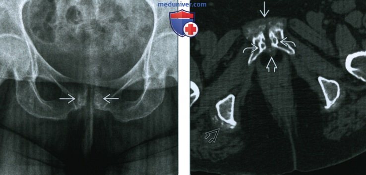 Нетравматический остеит лобковой кости - лучевая диагностика