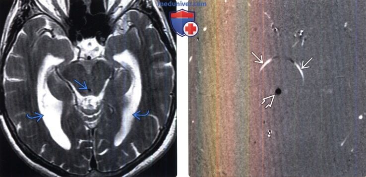 Нормотензивная гидроцефалия на МРТ головного мозга