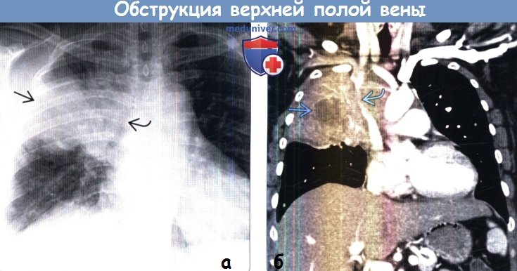 Обструкция верхней полой вены на рентгенограмме и КТ