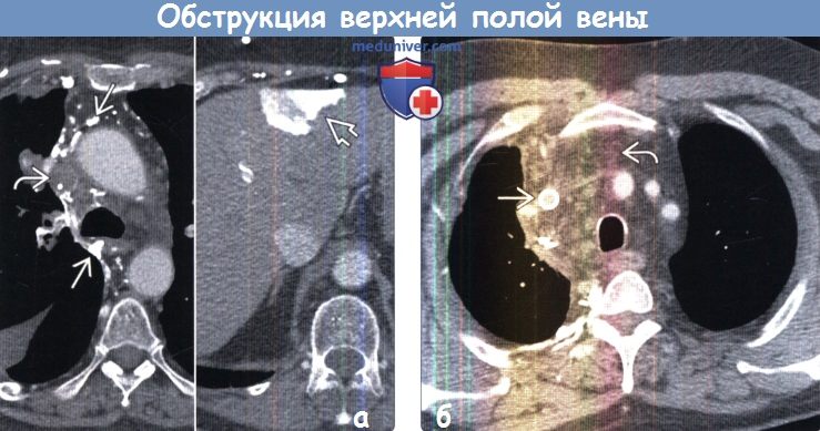Синдром верхней полой вены на рентгене thumbnail