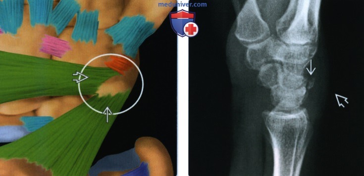 Послеоперационная оценка перелома ладьевидной кости