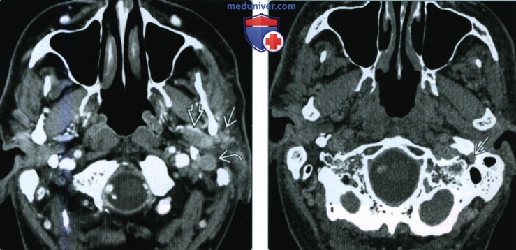 Периневральное распространение злокачественной опухоли околоушной слюнной железы в височную кость - лучевая диагностика