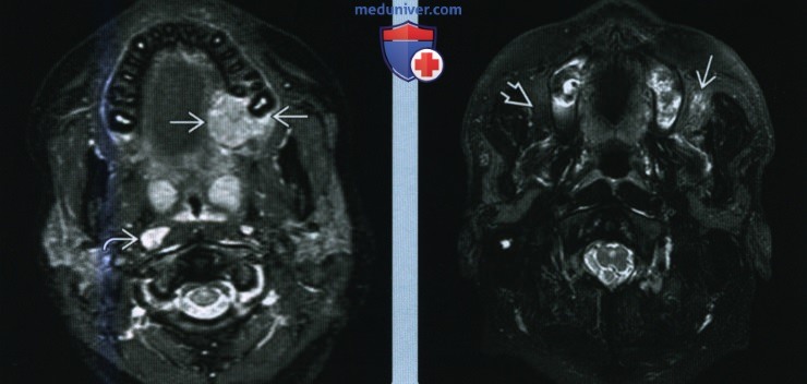 Злокачественная опухоль малой слюнной железы слизистого пространства глотки - лучевая диагностика