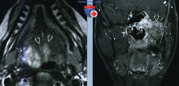 Злокачественная опухоль малой слюнной железы слизистого пространства глотки - лучевая диагностика