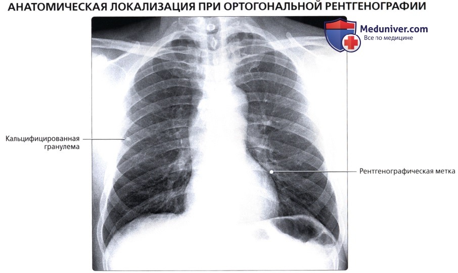 Анатомическая локализация при ортогональной рентгенографии органов грудной клетки