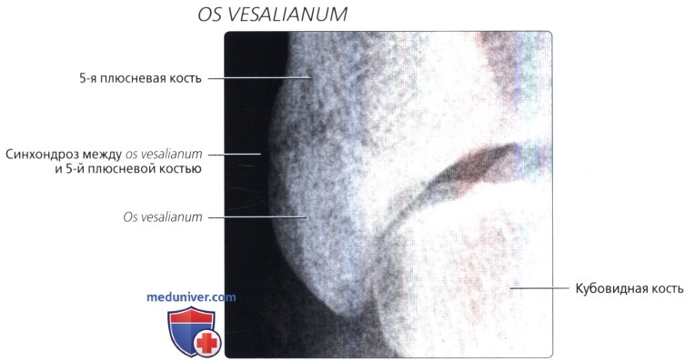 Os vesalianum на рентгенограмме