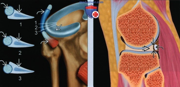 Лучевые особенности и варианты анатомии менисков коленного сустава