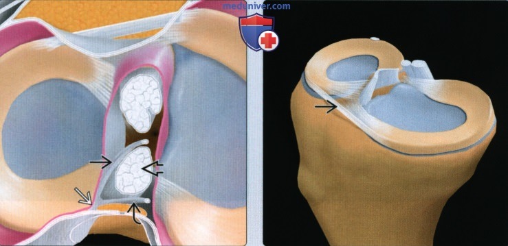 Лучевые особенности и варианты анатомии менисков коленного сустава