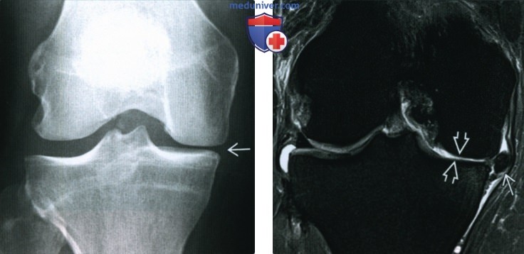 Остеоартроз коленного сустава - лучевая диагностика