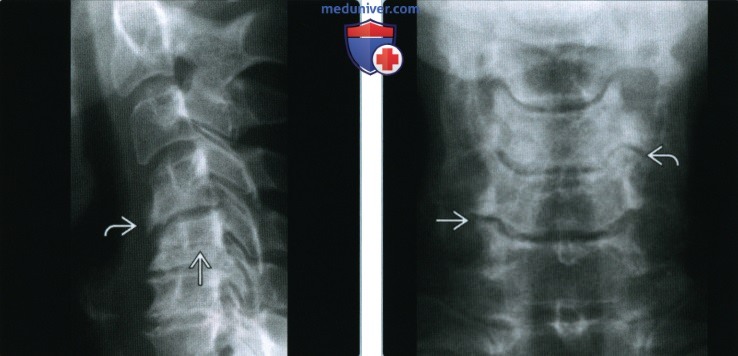 Остеоартроз осевого скелета - лучевая диагностика