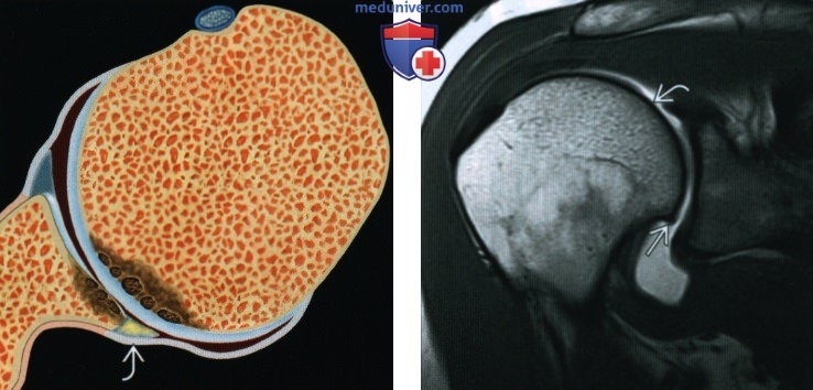 Остеоартроз плечевого и локтевого суставов - лучевая диагностика
