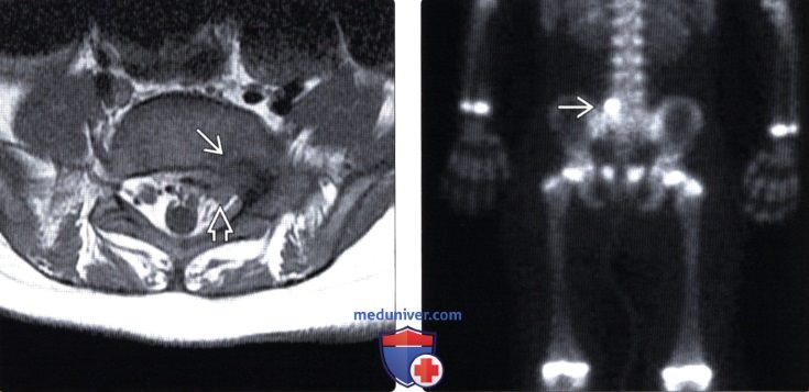 Рентгенограмма, КТ, сцинтиграмма остеоид-остеомы позвоночника