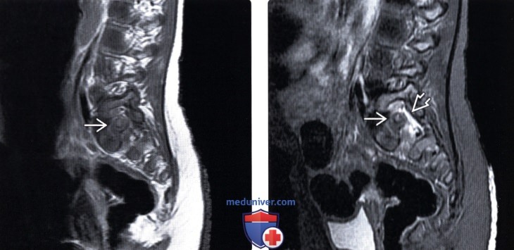 Рентгенограмма, КТ, сцинтиграмма остеоид-остеомы позвоночника