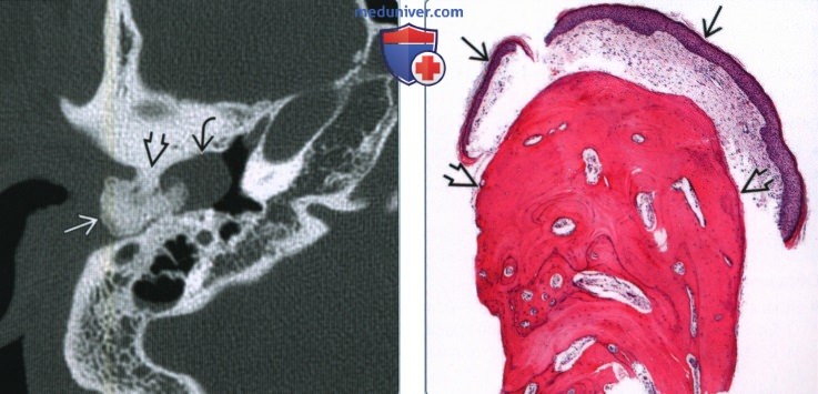 Остеома наружного слухового канала (НСК) - лучевая диагностика