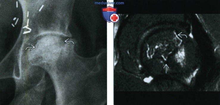 Остеонекроз бедренной кости - лучевая диагностика