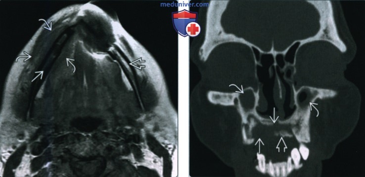 Остеонекроз верхней и нижней челюсти - лучевая диагностика