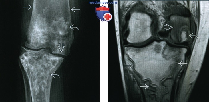 Остеонекроз коленного сустава - лучевая диагностика