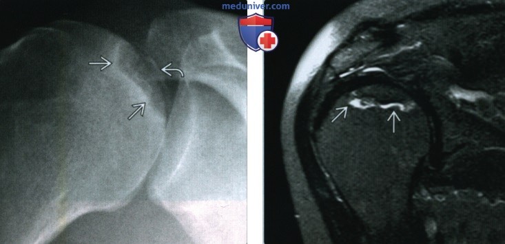 Остеонекроз плечевой кости - лучевая диагностика