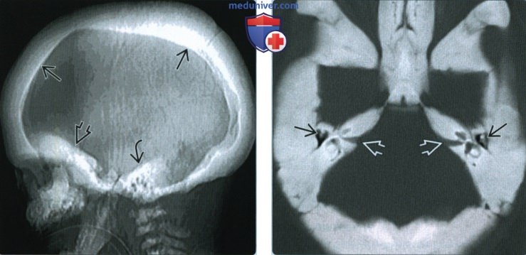 Остеопетроз основания черепа - лучевая диагностика