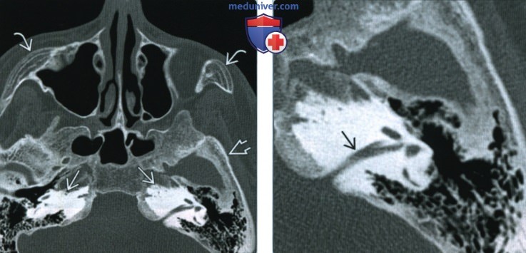 Остеопетроз основания черепа - лучевая диагностика