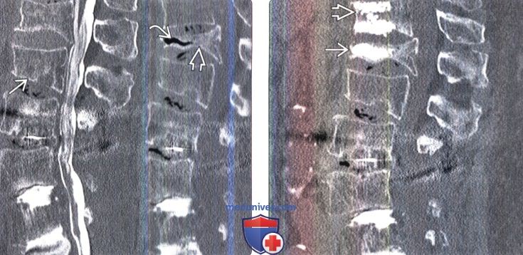 Рентгенограмма, КТ, МРТ при остеопорозе позвоночника