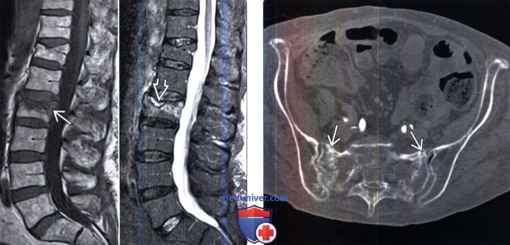 Рентгенограмма, КТ, МРТ при остеопорозе позвоночника
