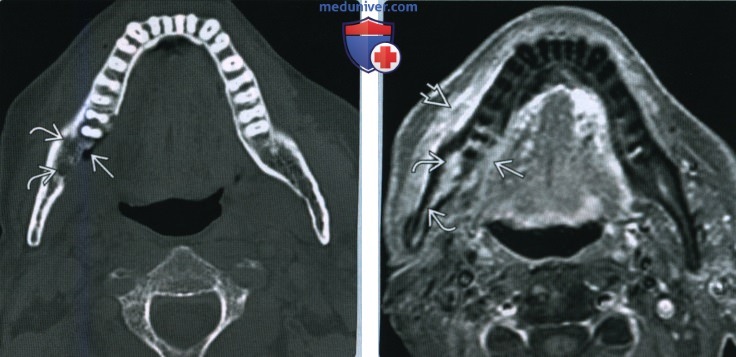 Остеорадионекроз головы и шеи - лучевая диагностика