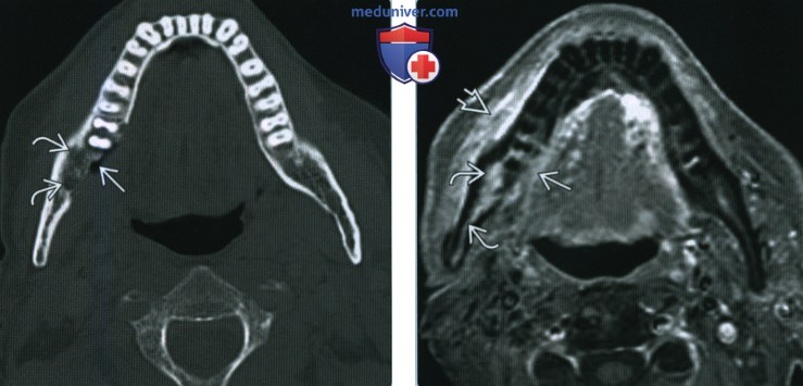 Остеорадионекроз нижней и верхней челюсти - лучевая диагностика
