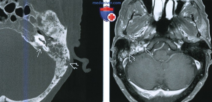 Остеорадионекроз височной кости - лучевая диагностика