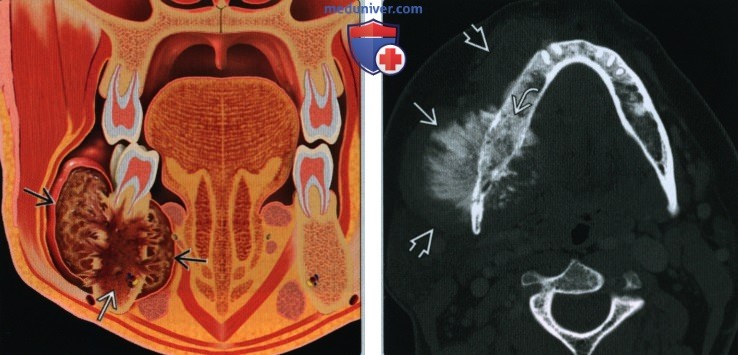 Остеосаркома верхней и нижней челюсти - лучевая диагностика