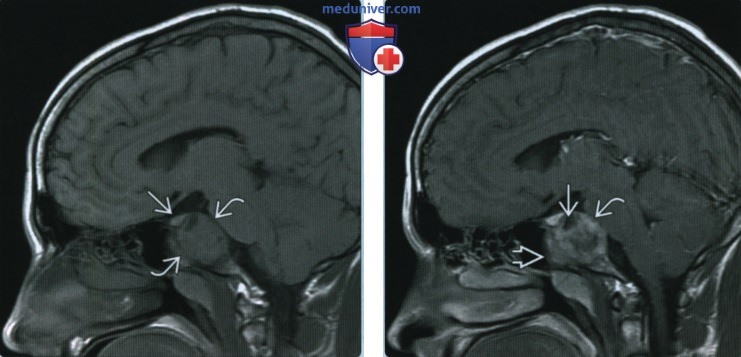 Остеосаркома основания черепа - лучевая диагностика
