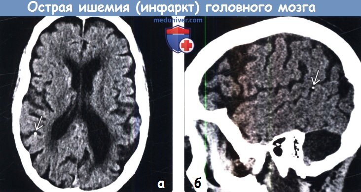 Острая ишемия (инфаркт головного мозга) на КТ