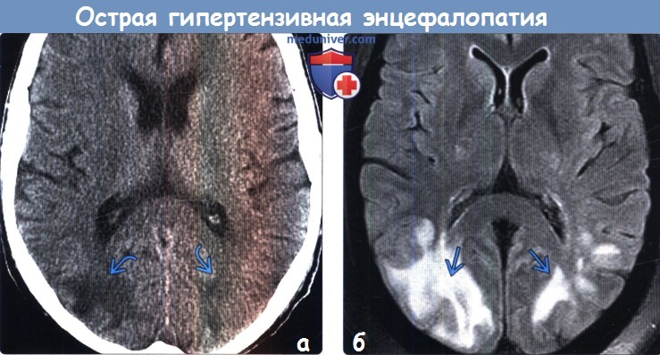 Острая гипертензивная энцефалопатия на КТ, МРТ головного мозга