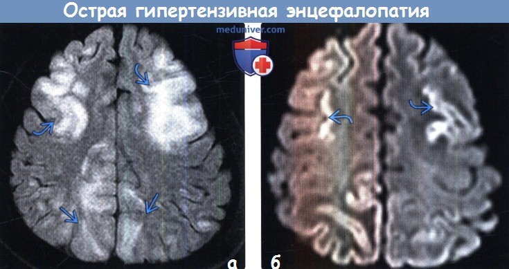 Острая гипертензивная энцефалопатия на КТ, МРТ головного мозга