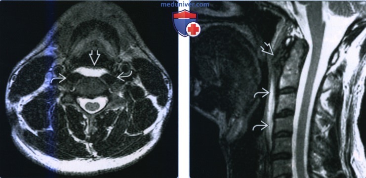 Острый кальцифицирующий тендинит сухожилия длинной мышцы шеи - лучевая диагностика