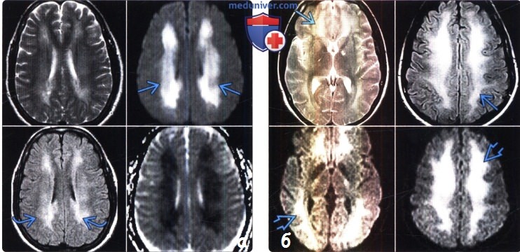 Отравление наркотиками на МРТ головного мозга